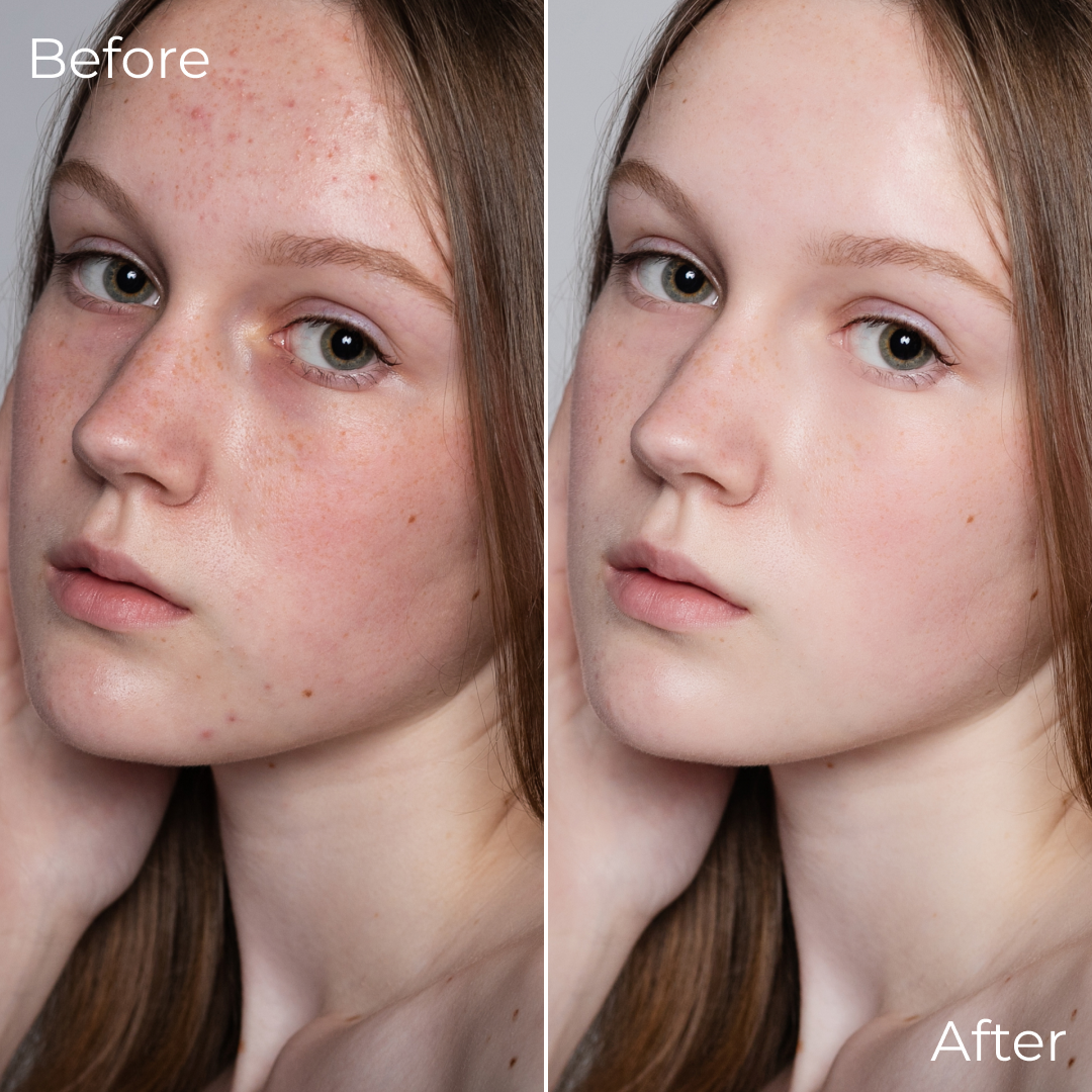 Acne treatment and skincare routine by Mana Beauty Lab.
